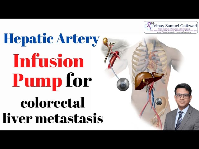 Hepatic Artery Infusion for Colorectal Liver Metastasis - Dr. Vinay Samuel Gaikwad