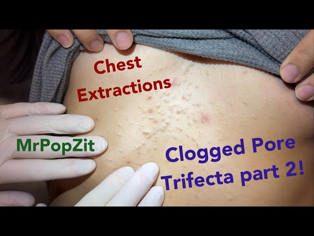 Clogged pores on the chest PART 2. Blackheads, steatos, and vellus hair cysts. Part 1 link below.