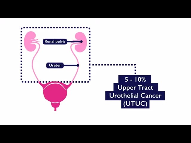 Upper Tract Urothelial Cancer
