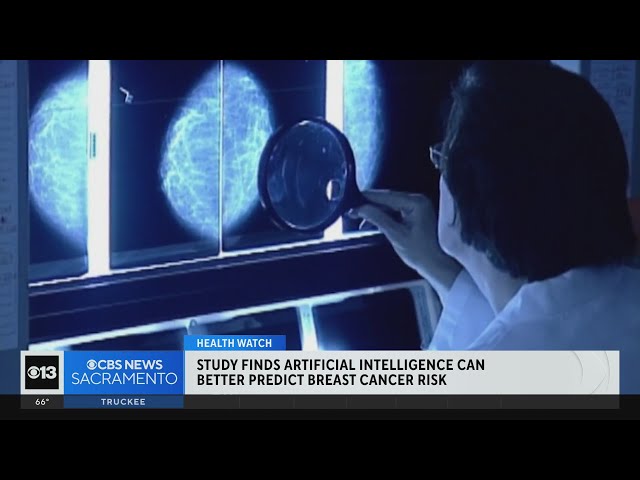 Study finds AI can better predict breast cancer risk