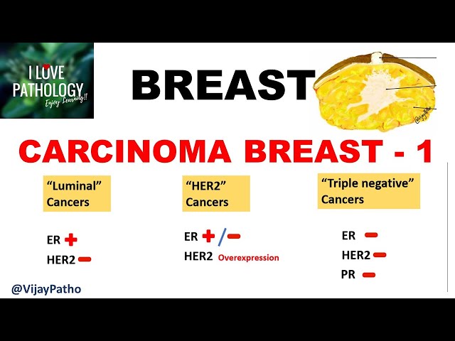 Diseases of Breast: Part 4: Breast carcinoma- risk factors, pathogenesis & classification