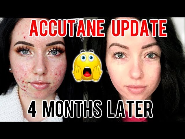 MY ACCUTANE JOURNEY 4 MONTH UPDATE Before & After, Progress, Side Effects...