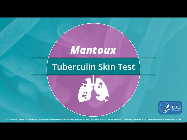 Mantoux Tuberculin Skin Test Video