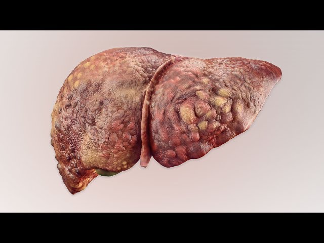 A Man Drank 3 Liters Rum Everyday Since Age 13. This is What Happened To His Liver.