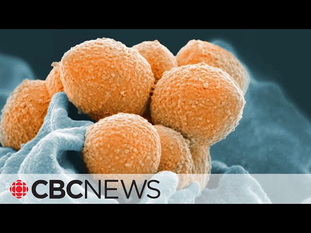 Invasive cases of Group A strep soar to record levels