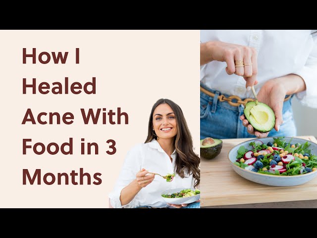 How I Got Clear Skin in 3 months (Natural Acne Treatment) Skin Transformation