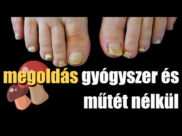 Nail fungus - and its solution without surgery or medicine
