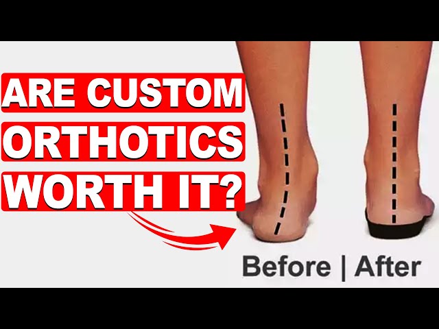 Are Custom Orthotics Worth It? [Plantar Fasciitis & Flat Feet]