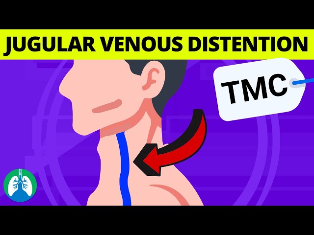 What are the Causes of Jugular Venous Distention (JVD)? | TMC Practice Question