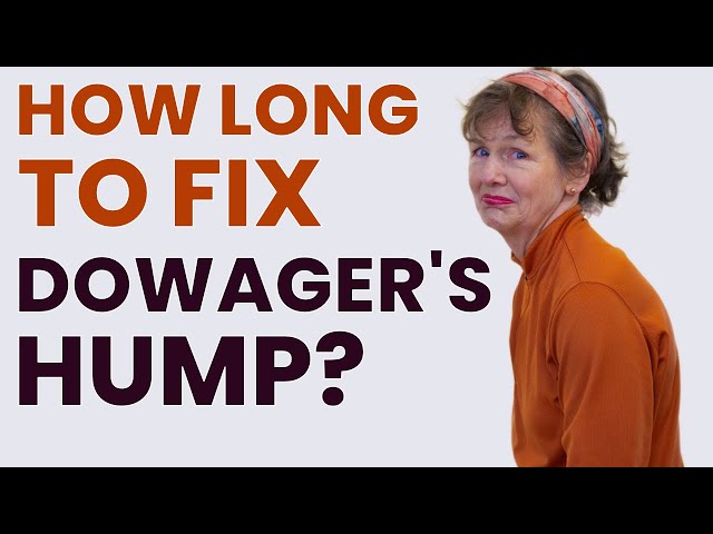 How Long to Correct Dowager’s Hump?