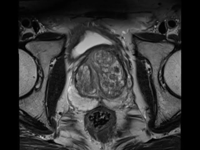Introduction to Prostate MRI and PI-RADS: Approach and Principles