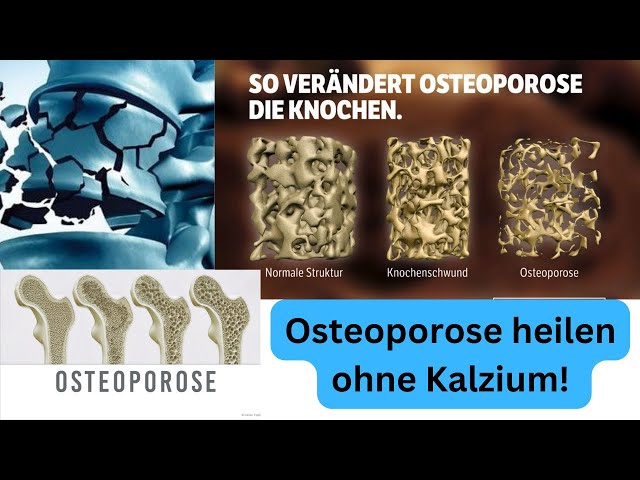 Osteoporosis is NOT a calcium problem!