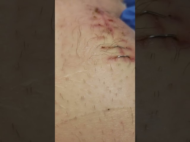 staples removed