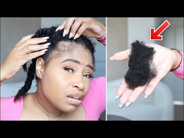 MY HAIR IS FALLING OUT IN CLUMPS! | How I Disguise It FAST