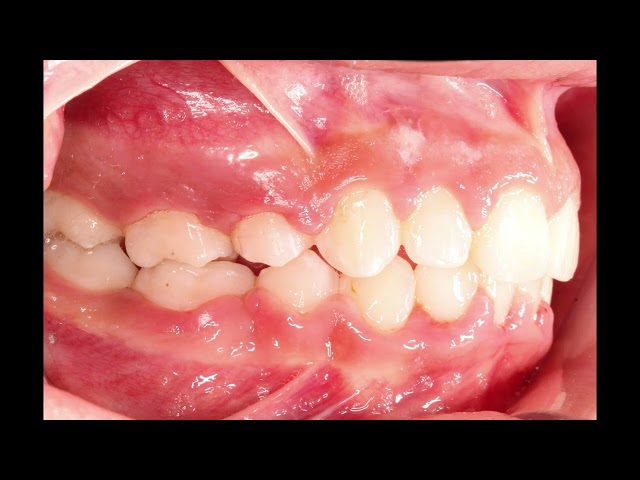 Crowded teeth? No problem! See how braces changed my smile.