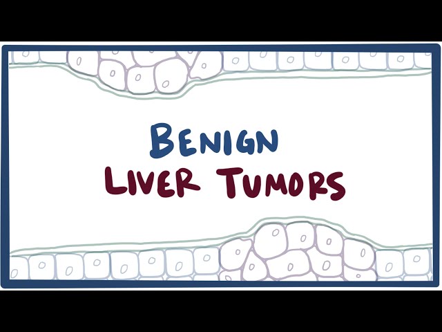 Benign liver tumors - causes, symptoms, diagnosis, treatment & pathology