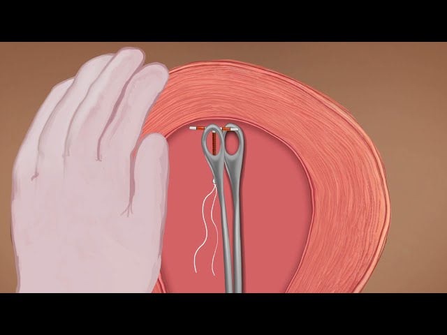 Inserting an IUD Postpartum, Teaching Short (Health Workers), English - Family Planning Series