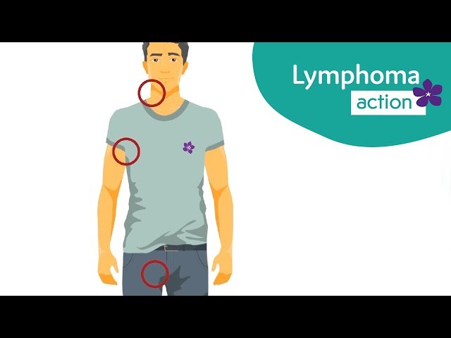 The symptoms of lymphoma