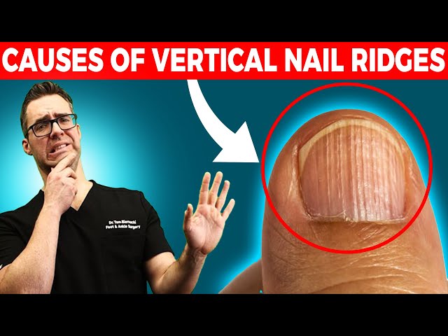 🖐Do you have Vertical Nail Ridges?  [Causes & Treatment]🖐