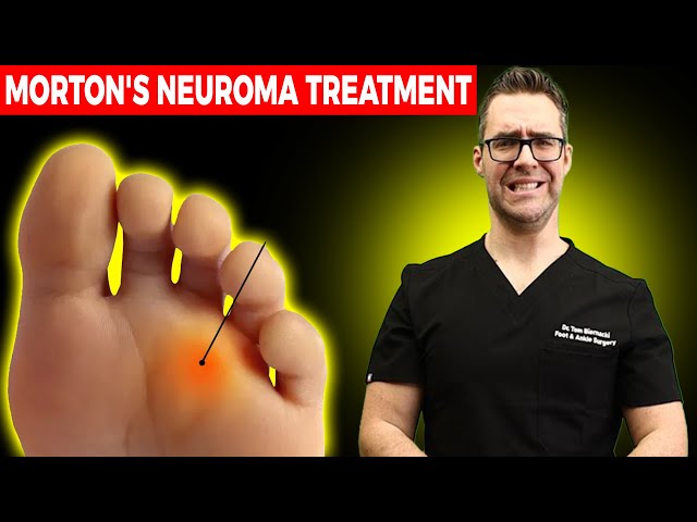 11 BEST Mortons Neuroma Massage, Exercise & Stretch Treatments [WOW!]