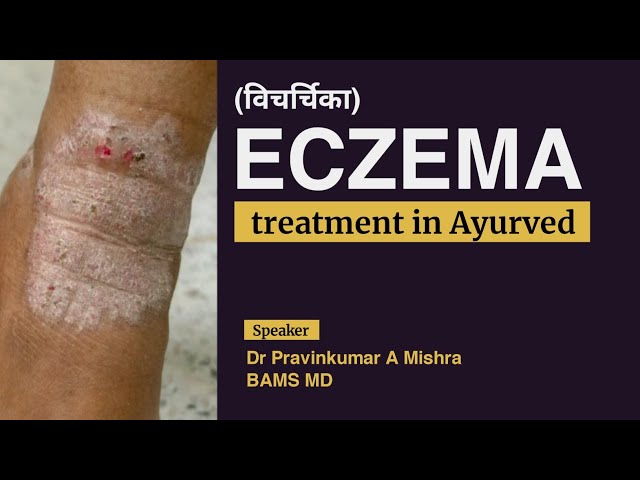 How to start Treatment of Eczema in Ayurved  - Dr Pravinkumar A Mishra