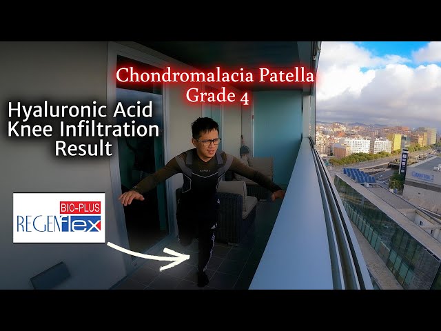 Hyaluronic Acid Knee Injection Result | Chondromalacia Patella Grade 4