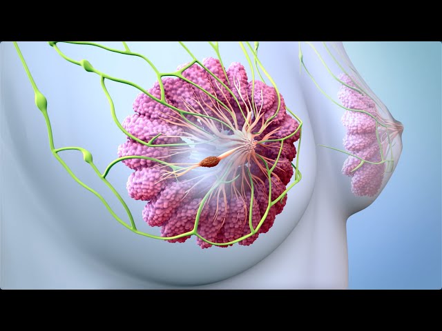 What are Some of the Treatment Options for Breast Cancer?