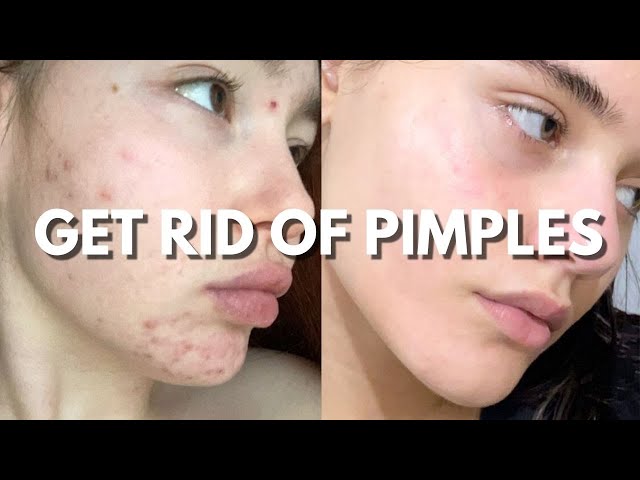 how to get rid of pimples 🤍🌷tips for clear skin and acne treatment