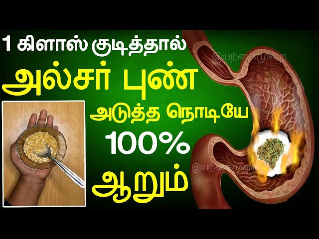 1 ஸ்பூன் 1 கிளாஸ் கண்டிப்பா அல்சர் உடனே ஆறிவிடும் | Iyarkai murai | Ulcer gunmaaga | Ulcer | அல்சர்
