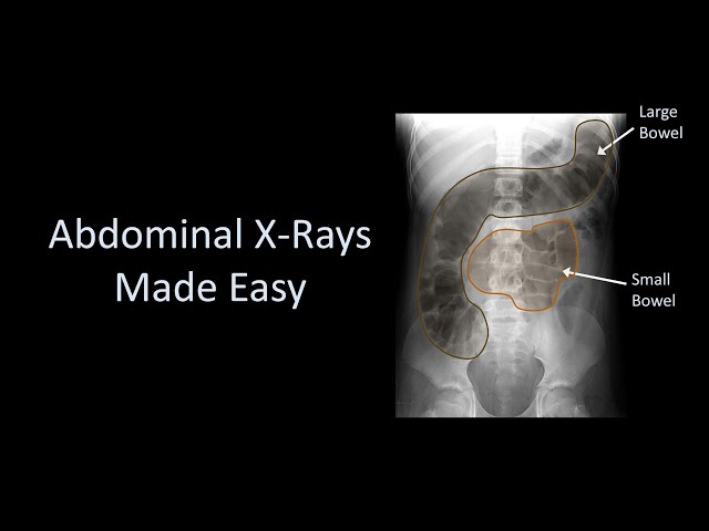 Abdominal X-Rays Made Easy