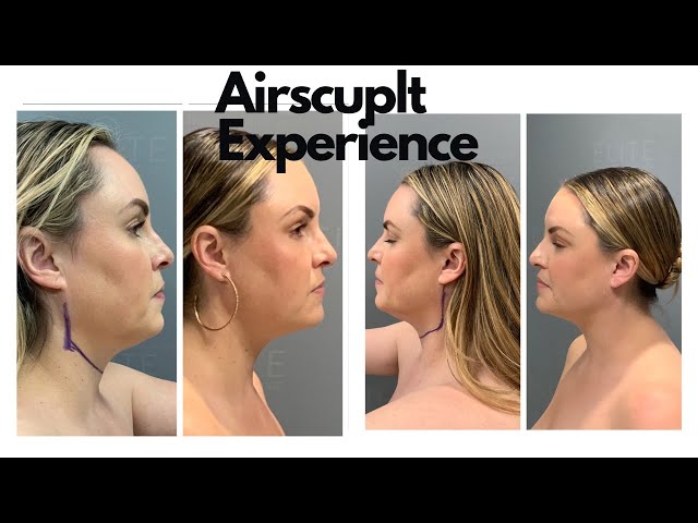Go Under the Knife with me - Vlog Airsculpt