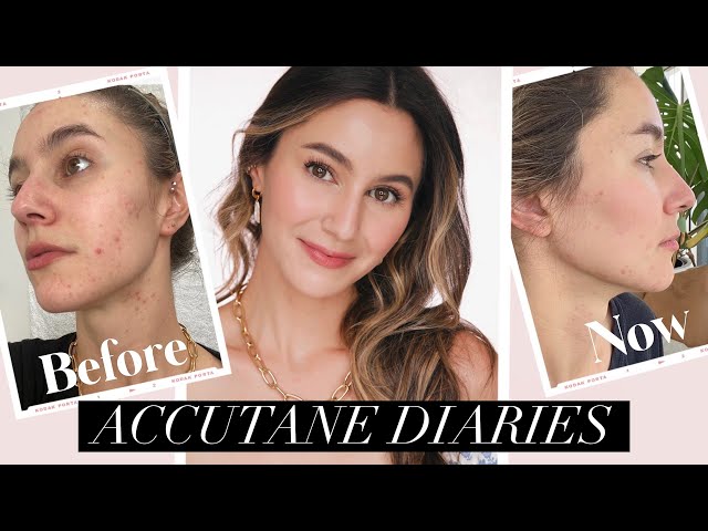 Why I Started Accutane 💊 Acne Diary & Weekly Updates ✖️ Low Dose Isotretinoin | Karima McKimmie