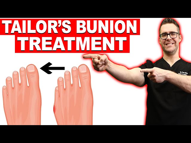 #1 Tailor's Bunion & Bunionette Treatment? [Correctors? Surgery?]