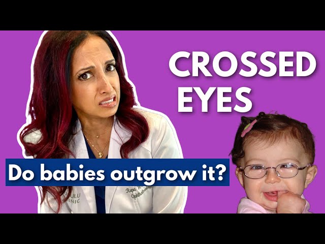 Eye Crossing in Babies: Do They Outgrow It?