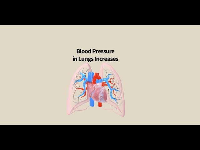 High Blood Pressure in the Lungs: Understanding PAH