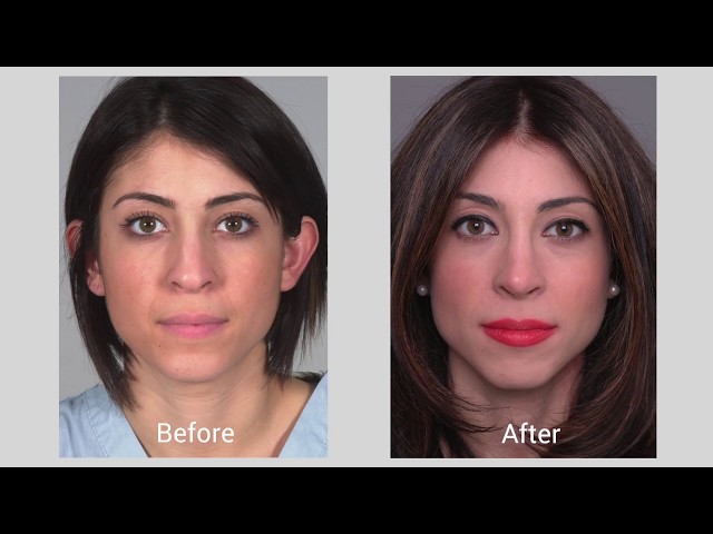Who should I go to and what should I expect when getting a rhinoplasty?