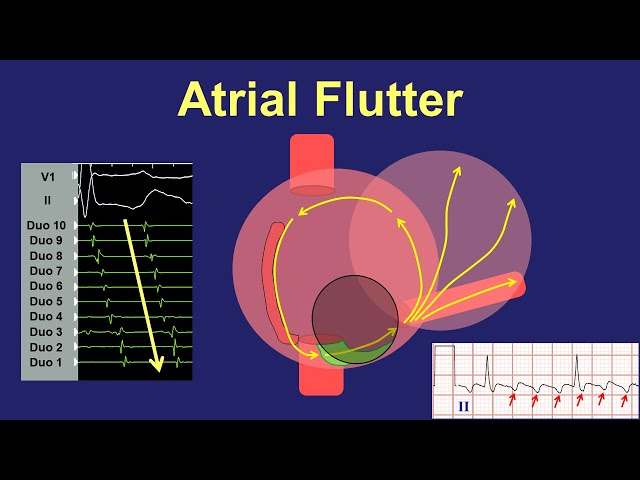 Atrial Flutter - Fundamentals of Diagnosis and Ablation