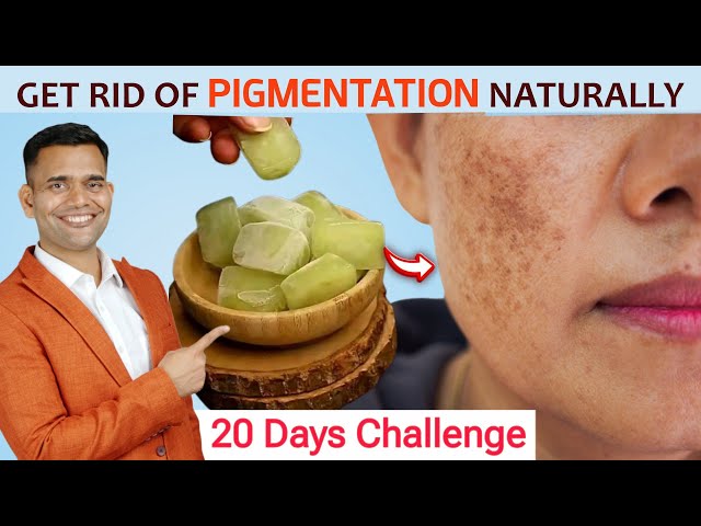 20 Days Challenge | Get Rid Of Pigmentation, Melasma Dark Spot Naturally