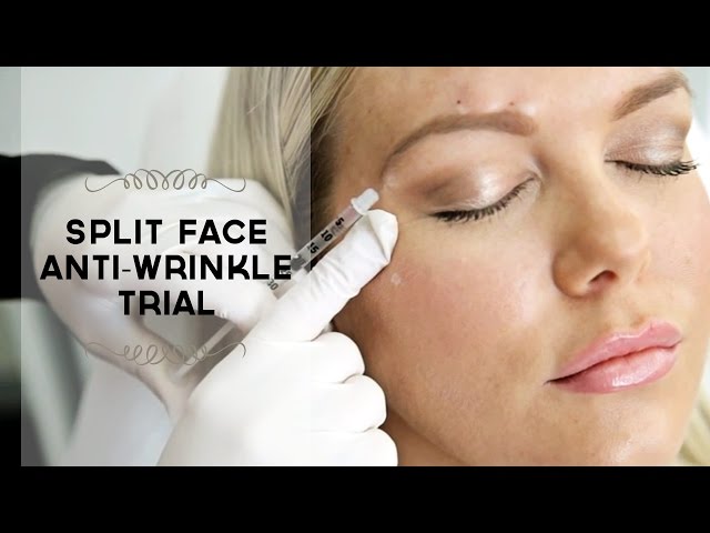 Split-face trial of two anti-wrinkle injections