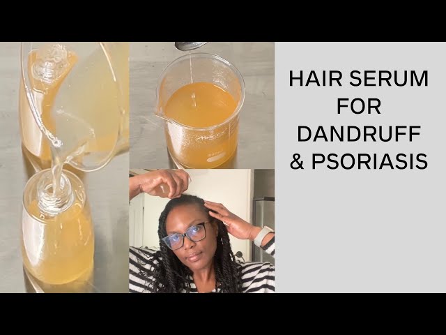 DIY: Hair Serum For Dandruff & Scalp Psoriasis/For Dry Itchy Scalp