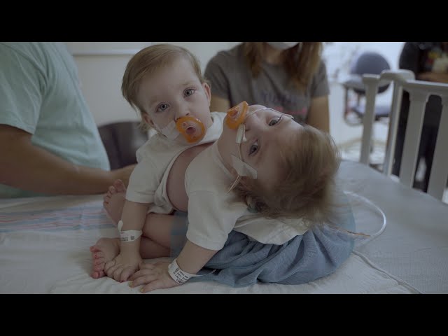 Michigan Medicine Team Separates Conjoined Twins at C.S. Mott Children’s Hospital