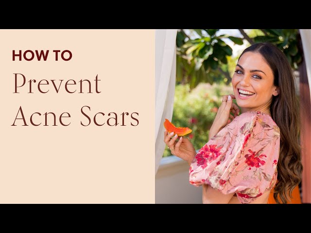 How to Prevent Acne Scars