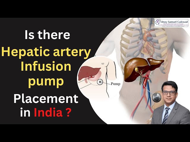 Hepatic Artery Infusion Pump Placement In India | Dr. Vinay Samuel Gaikwad - Surgical oncologist