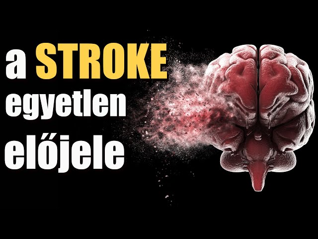 The only indicator of stroke - you absolutely need to know about it