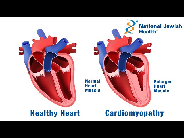 What Is Cardiomyopathy?