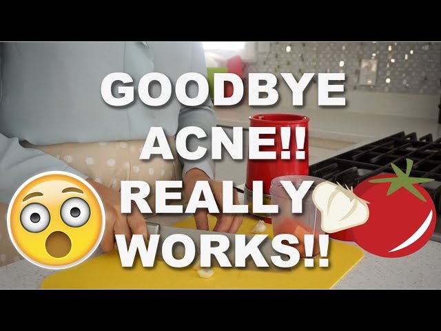 HOW TO GET RID OF ACNE! BEST HOME REMEDY FOR GETTING RID OF ACNE!!