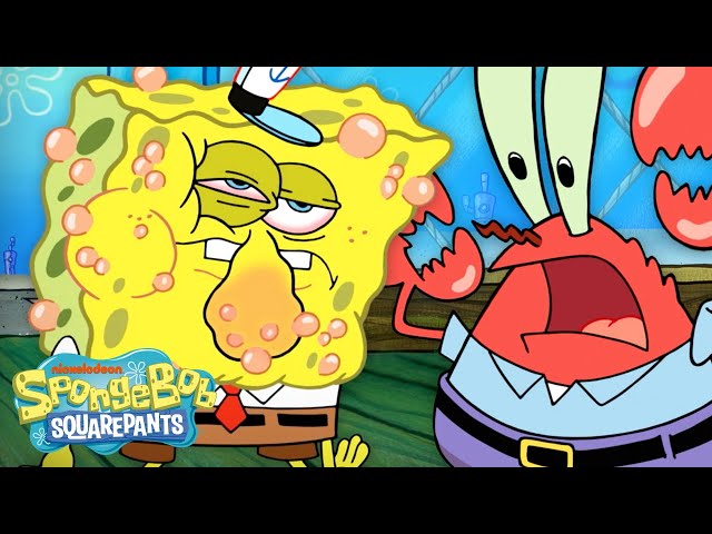 Is SpongeBob Allergic To Krabby Patties?! 😱 "Allergy Attack" Full Scene | SpongeBob
