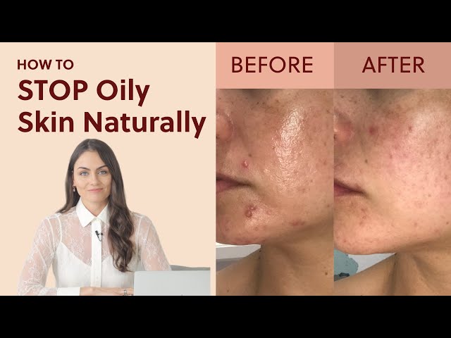 How to Stop Oily Skin Naturally (4 Proven Tips)