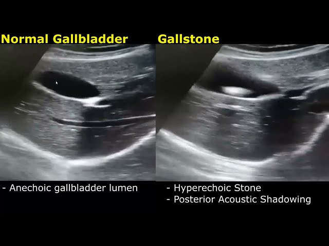 Gallstone Ultrasound Real-Time Scan Normal Vs Abnormal Appearance | Cholelithiasis | Gallbladder USG