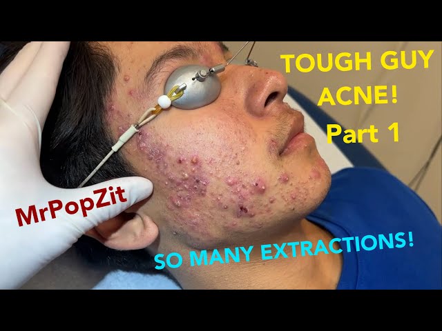 Severe hormonal acne in young patient. So many clogged pores expressed. Explosive inflammation!